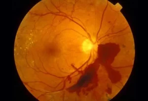 اعتلال شبكية العين يعتبر من الاضرار التي تلحق بالعين نتيجة مرض السكري