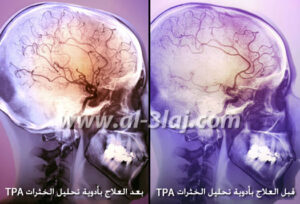 علاج الجلطة الدماغية بأدوية تحليل الخثرات TPA القوية و التي تعمل على تحليل الخثرات المتكونة في الدماغ
