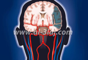 رسم يوضح تلف جزء من الدماغ بعد الاصابة بالسكتة الدماغية