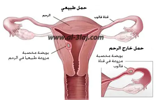 الحمل خارج الرحم يحدث عندما تزرع البويضة المخصبة نفسها في مكان خراج الرحم و ليس في بطانة الرحم كما يحدث في الحمل الطبيعي، و غالبا يكون هذا المكان قناة فالوب