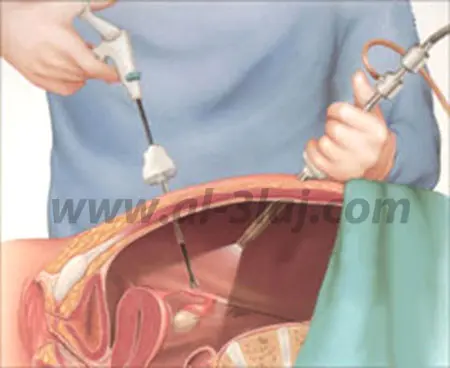 جراحة المنظار المستخدمة في علاج الحمل خارج الرحم حيث يتم ازالة الحمل خارج الرحم و اصلاح قناة فالوب باستخدام المنظار الجراحي الذي يتم ادخاله من خلال شق صغير في البطن