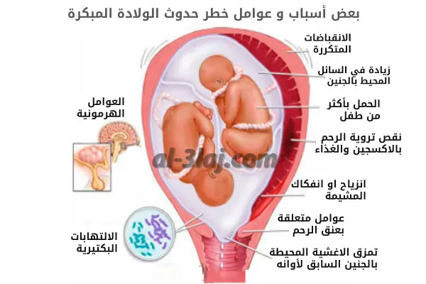 رسم تو توضح بعض عوامل خطر و اسباب الولادة المبكرة عند الحامل التي تشمل الانقباضات المتكررة و الحمل بتوأم و زيادة السائل و الالتهابات و غيرها