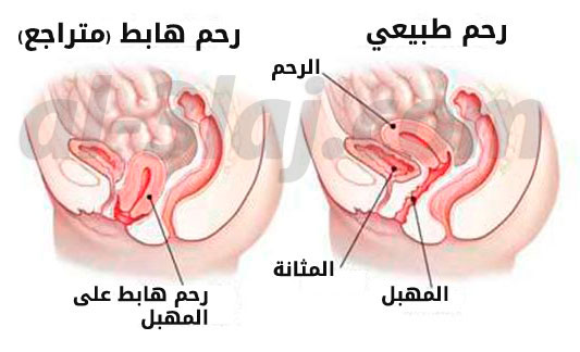 رسم توضيحي لهبوط أو تراجع الرحم نحو المهبل الذي يعتبر من اسباب سلس البول عند النساء